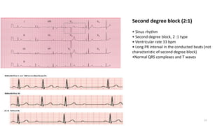Second degree block (2:1)
• Sinus rhythm
• Second degree block, 2 :1 type
• Ventricular rate 33 bpm
• Long PR interval in the conducted beats (not
characteristic of second degree block)
•Normal QRS complexes and T waves
12
 