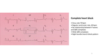 Complete heart block
• Sinus rate 70 bpm
• Regular ventricular rate, 40 bpm
• No relationship between P waves
and QRS complexes
• Wide QRS complexes
• Right bundle branch block pattern
13
 