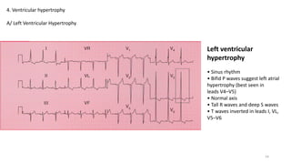 4. Ventricular hypertrophy
A/ Left Ventricular Hypertrophy
Left ventricular
hypertrophy
• Sinus rhythm
• Bifid P waves suggest left atrial
hypertrophy (best seen in
leads V4–V5)
• Normal axis
• Tall R waves and deep S waves
• T waves inverted in leads I, VL,
V5–V6
14
 