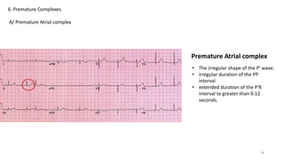 6. Premature Complexes
A/ Premature Atrial complex
• The irregular shape of the P' wave.
• irregular duration of the PP
interval
• extended duration of the P'R
interval to greater than 0.12
seconds.
Premature Atrial complex
18
 
