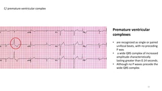 Premature ventricular
complexes
• are recognized as single or paired
unifocal beats, with no preceding
P wav.
• a wide QRS complex of increased
amplitude characteristically
lasting greater than 0.14 seconds.
• Although no P waves precede the
wide QRS complex
C/ premature ventricular complex
19
 