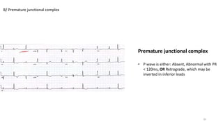 • P wave is either: Absent, Abnormal with PR
< 120ms, OR Retrograde, which may be
inverted in inferior leads
B/ Premature junctional complex
Premature junctional complex
20
 
