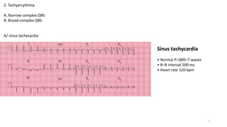 2. Tachyarrythmia
A, Narrow complex QRS
B. Broad complex QRS
A/ sinus tachycardia
Sinus tachycardia
• Normal P–QRS–T waves
• R–R interval 500 ms
• Heart rate 120 bpm
5
 