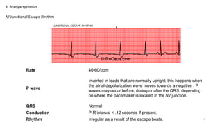 3. Bradyarrythmias
A/ Junctional Escape Rhythm
Rate 40-60/bpm
P wave
Inverted in leads that are normally upright; this happens when
the atrial depolarization wave moves towards a negative . P
waves may occur before, during or after the QRS, depending
on where the pacemaker is located in the AV junction.
QRS Normal
Conduction P-R interval < .12 seconds if present.
Rhythm Irregular as a result of the escape beats. 9
 