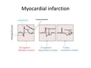 Myocardial infarction
 