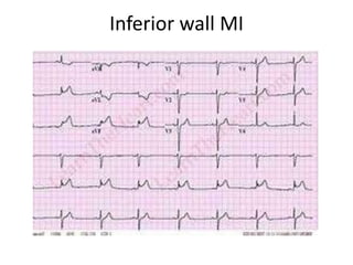 Inferior wall MI
 