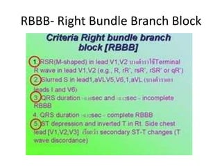 RBBB- Right Bundle Branch Block
 