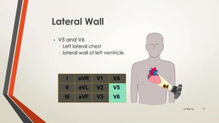 Lateral Wall
 V5 and V6
◦ Left lateral chest
◦ lateral wall of left ventricle
I
II
III
aVR
aVL
aVF
V1
V2
V3
V4
V5
V6
1624-May-14
 