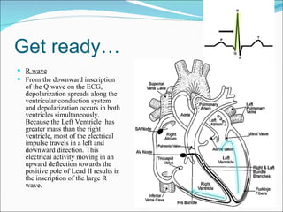 Get ready… R wave From the downward inscription of the Q wave on the ECG, depolarization spreads along the ventricular conduction system and depolarization occurs in both ventricles simultaneously. Because the Left Ventricle  has greater mass than the right ventricle, most of the electrical impulse travels in a left and downward direction. This electrical activity moving in an upward deflection towards the positive pole of Lead II results in the inscription of the large R wave.  