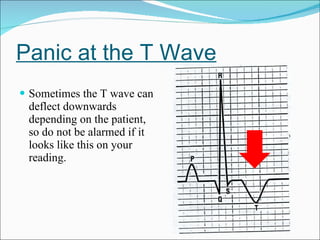 Panic at the T Wave Sometimes the T wave can deflect downwards depending on the patient, so do not be alarmed if it looks like this on your reading. 