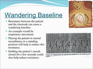 Wandering Baseline Resistance between the patient and the electrode can cause a wandering baseline.  An example would be respiratory movement. Placing the patient in sternal recumbancy or a standing position will help to reduce this resistance. Holding the patient’s mouth closed for a few seconds could also help reduce resistance. 