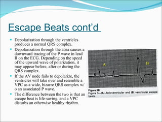 Escape Beats cont’d  Depolarization through the ventricles produces a normal QRS complex. Depolarization through the atria causes a downward tracing of the P wave in lead II on the ECG. Depending on the speed of the upward wave of polarization, it may appear before, after or during the QRS complex.  If the AV node fails to depolarize, the ventricles will take over and resemble a VPC as a wide, bizarre QRS complex w/o an associated P wave.  The difference between the two is that an escape beat is life-saving, and a VPC disturbs an otherwise healthy rhythm. A B 