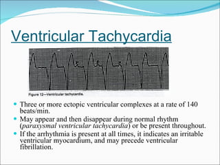 Ventricular Tachycardia Three or more ectopic ventricular complexes at a rate of 140 beats/min. May appear and then disappear during normal rhythm ( paraxysmal ventricular tachycardia ) or be present throughout. If the arrhythmia is present at all times, it indicates an irritable ventricular myocardium, and may precede ventricular fibrillation. 