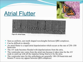Atrial Flutter Seen as uniform, saw-tooth shaped wavelengths between QRS complexes.  Can be difficult to identify. An atrial flutter is a rapid atrial depolarization which occurs at the rate of 250 -350 beats/min. The AV node becomes flooded with depolarizations from the atria. The ventricular rate varies from the atrial rate because it takes time for the AV node to catch up with all the impulses being fired at it by the atria.  The ventricular rates for this arrhythmia are generally 140-150 beats/min and bizarre P waves my appear between QRS complexes.  