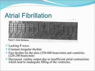 Atrial Fibrillation Lacking P wave Constant irregular rhythm Fast rhythm for the atria (350-600 beats/min) and ventricles (220-240 beats/min) Decreased  cardiac output due to insufficient atrial contractions which lead to inadequate filling of the ventricles. 