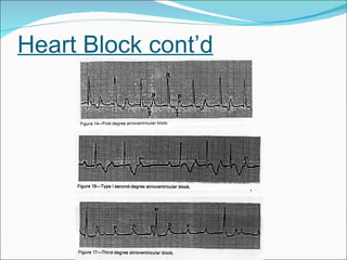 Heart Block cont’d 
