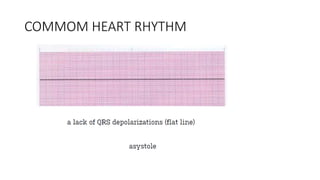 Common Heart Rythmns ECG-Interpretation-1.pptx
