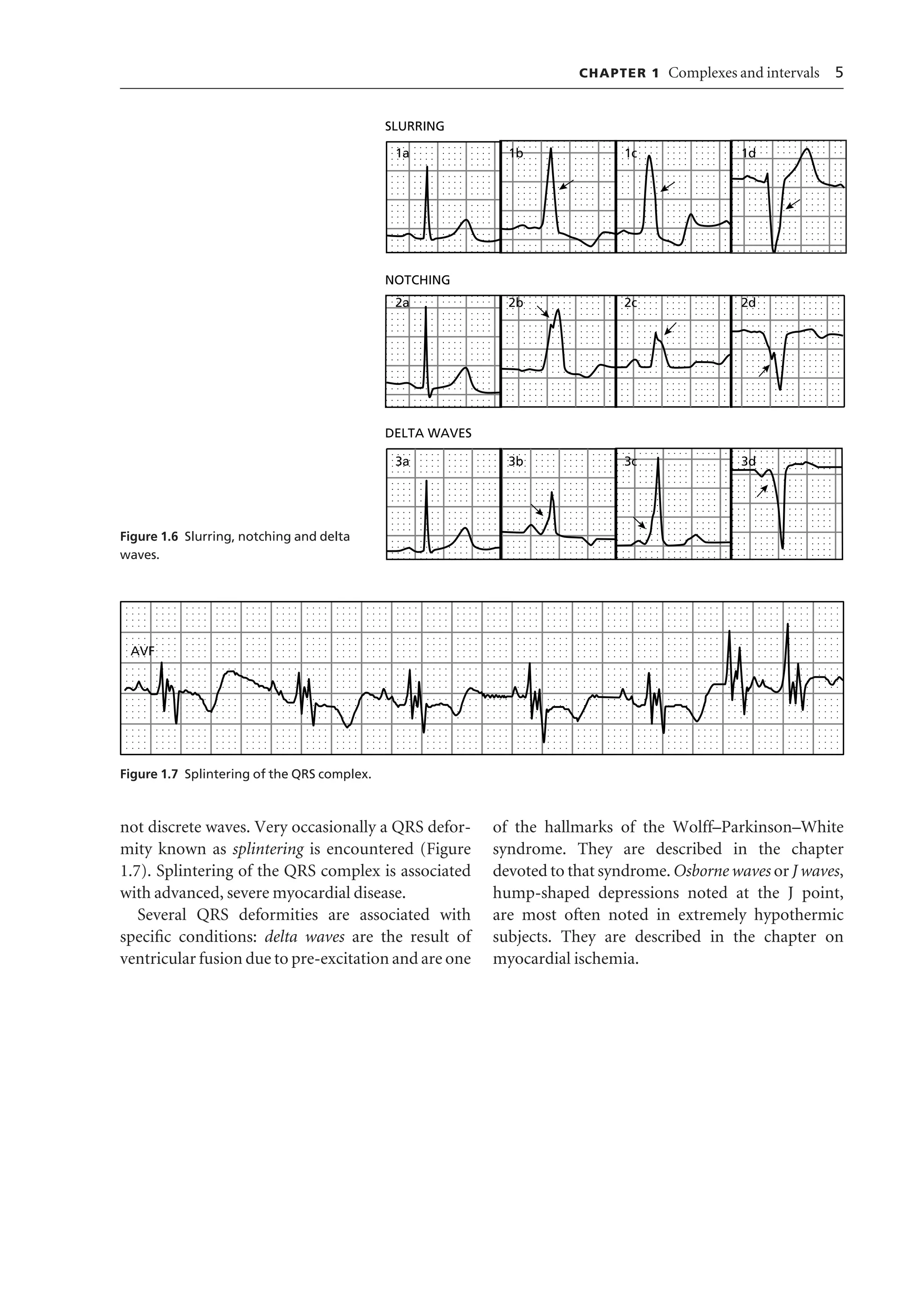 Ecg interpretation | PDF | Heart and Cardiovascular Diseases | Diseases ...