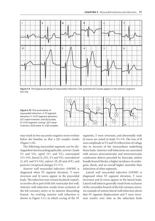Ecg interpretation | PDF