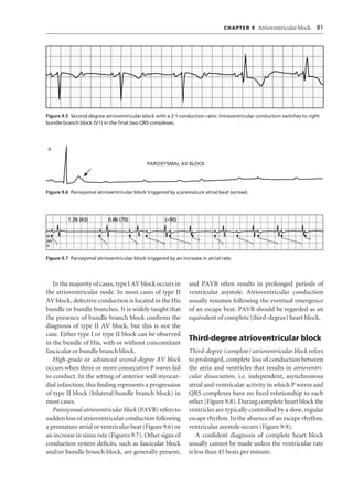V1 Conduction Block Ecg interpretation | PDF