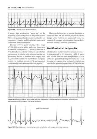 Ecg interpretation | PDF