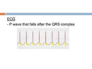 ECG
- P wave that falls after the QRS complex

 