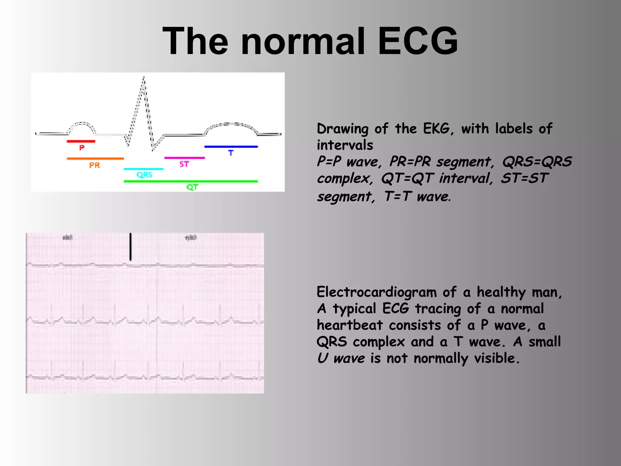 The normal ECG Drawing of the EKG, with labels of intervals P=P wave, PR=PR segment, QRS=QRS complex, QT=QT interval, ST=ST segment, T=T wave . Electrocardiogram of a healthy man,  A typical ECG tracing of a normal heartbeat consists of a P wave, a QRS complex and a T wave. A small  U wave  is not normally visible. 