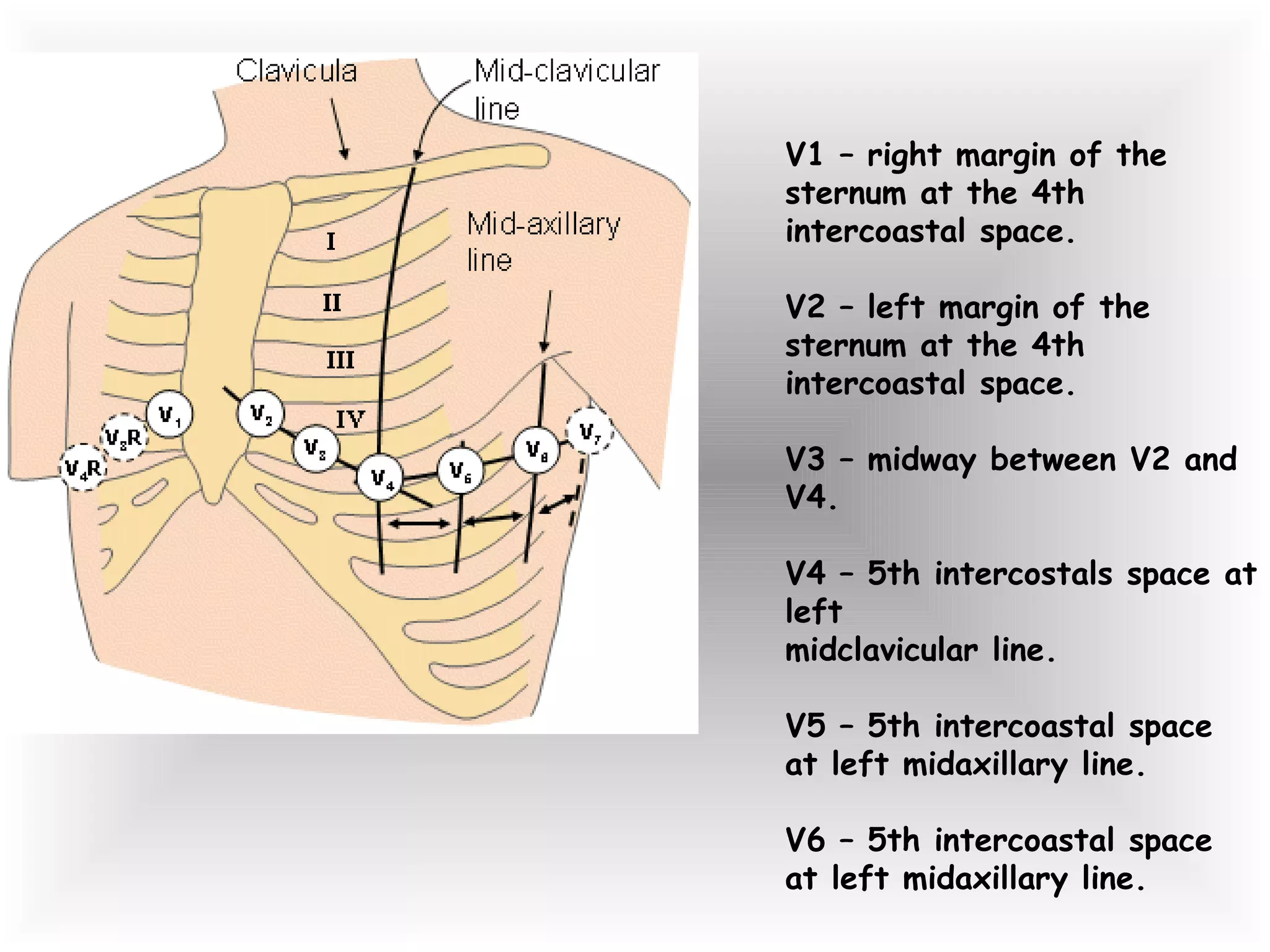 V1 – right margin of the sternum at the 4th intercoastal space. V2 – left margin of the sternum at the 4th intercoastal space. V3 – midway between V2 and V4. V4 – 5th intercostals space at left  midclavicular line. V5 – 5th intercoastal space at left midaxillary line. V6 – 5th intercoastal space at left midaxillary line. 