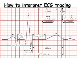 How to interpret ECG tracing   