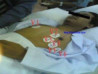 V 1 V 2 V 3 V 4 V 5 V 6 Mid-Clavicular line 