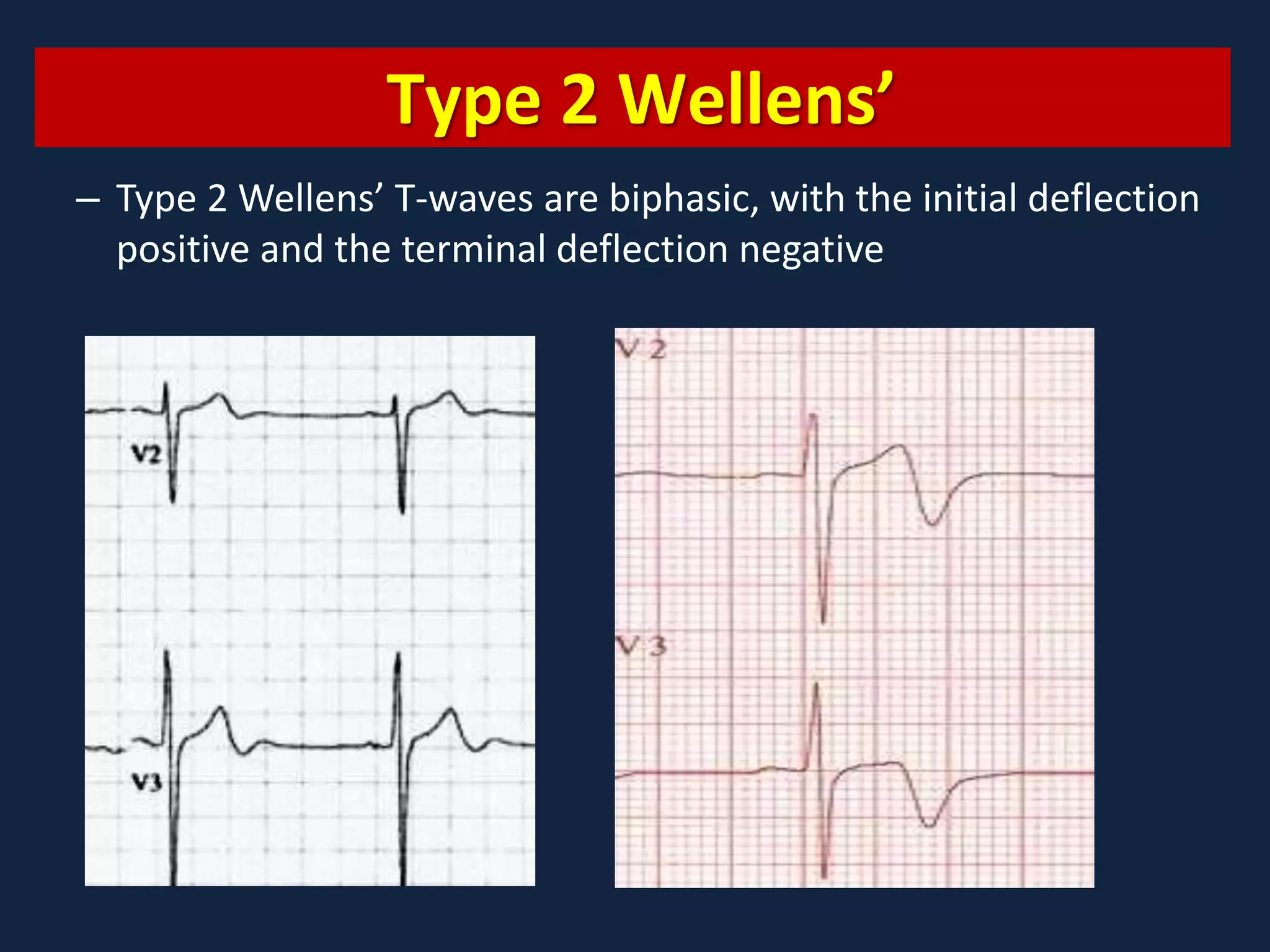 Myocardial Ischemia And Infarction PPTX