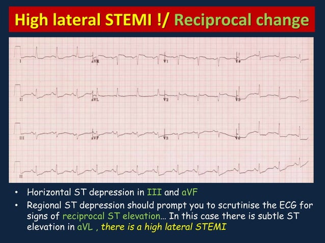 Myocardial Ischemia and Infarction | PPTX