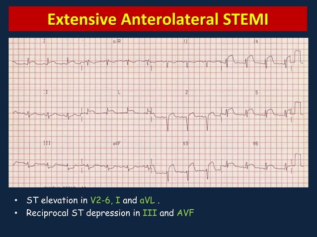 Myocardial Ischemia and Infarction | PPTX
