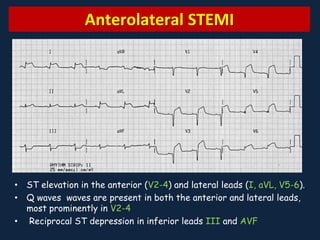 Ischemia Vs Infarction Ecg