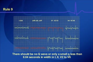 Rule 9 There should be no Q wave or only a small q less than 0.04 seconds in width in I, II, V2 to V6  I II III aVR aVL aVF V1  V2 V3 V4  V5 V6 