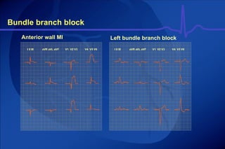 Bundle branch block I II III aVR aVL aVF V1  V2 V3 V4  V5 V6 I II III aVR aVL aVF V1  V2 V3 V4  V5 V6 Anterior wall MI Left bundle branch block 