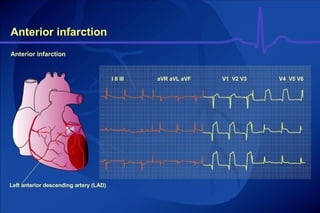 Anterior infarction Anterior infarction Left anterior descending artery (LAD) I II III aVR aVL aVF V1  V2 V3 V4  V5 V6 
