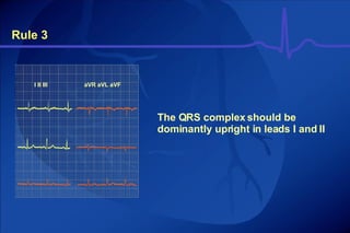 Rule 3 The QRS complex should be dominantly upright in leads I and II I II III aVR aVL aVF 