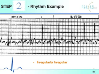STEP - Rhythm Example
• Irregularly Irregular
20
19
 
