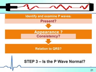 STEP 3 – Is the P Wave Normal?
Relation to QRS?
Appearance ?
Consistency?
Identify and examine P waves:
Present?
21
20
 