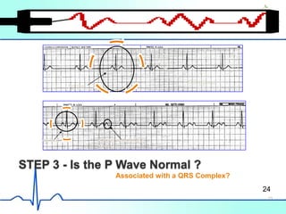 STEP 3 - Is the P Wave Normal ?
Normal P wave with no QRS
complex
Normal
Same Shape
Associated with a QRS Complex?
24
23
 
