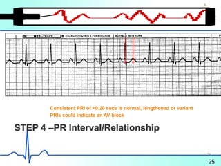 STEP 4 –PR Interval/Relationship
Consistent PRI of <0.20 secs is normal, lengthened or variant
PRIs could indicate an AV block
25
24
 