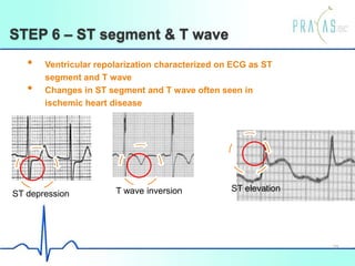 STEP 6 – ST segment & T wave
• Ventricular repolarization characterized on ECG as ST
segment and T wave
• Changes in ST segment and T wave often seen in
ischemic heart disease
ST depression T wave inversion ST elevation
29
 