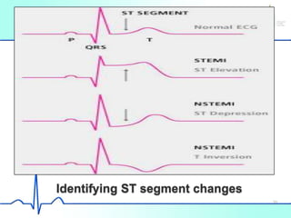 Identifying ST segment changes
30
 