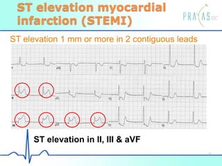 ST elevation myocardial
infarction (STEMI)
ST elevation 1 mm or more in 2 contiguous leads
ST elevation in II, III & aVF
32
 