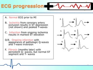 Evolving infarction:
ECG progression
A. Normal ECG prior to MI
B. Ischemia from coronary artery
occlusion results in ST depression
(not shown) and peaked T-waves
C. Infarction from ongoing ischemia
results in marked ST elevation
D/E. Ongoing infarction with
appearance of pathologic Q-waves
and T-wave inversion
F. Fibrosis (months later) with
persistent Q- waves, but normal ST
segment and T- waves
33
 