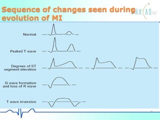 Sequence of changes seen during
evolution of MI
34
 