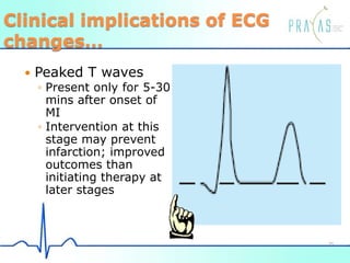 Clinical implications of ECG
changes…
 Peaked T waves
◦ Present only for 5-30
mins after onset of
MI
◦ Intervention at this
stage may prevent
infarction; improved
outcomes than
initiating therapy at
later stages
35
 