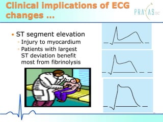 Clinical implications of ECG
changes …
 ST segment elevation
◦ Injury to myocardium
◦ Patients with largest
ST deviation benefit
most from fibrinolysis
36
 