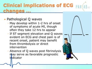 Clinical implications of ECG
changes …
 Pathological Q waves
◦ May develop within 1-2 hrs of onset
of symptoms of acute MI, though
often they take 12 hrs to appear
◦ If ST segment elevation and Q waves
evident on ECG and chest pain is of
recent onset, patient may benefit
from thrombolysis or direct
intervention
◦ Absence of Q waves post fibrinolysis
may serve as favorable prognostic
indicator
37
 